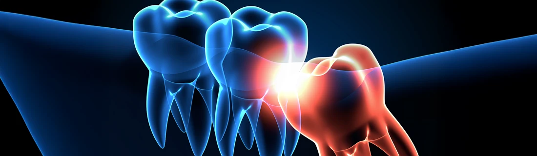 A digital illustration of teeth, with one being red, contrasting with the blue depiction of the other healthy teeth.